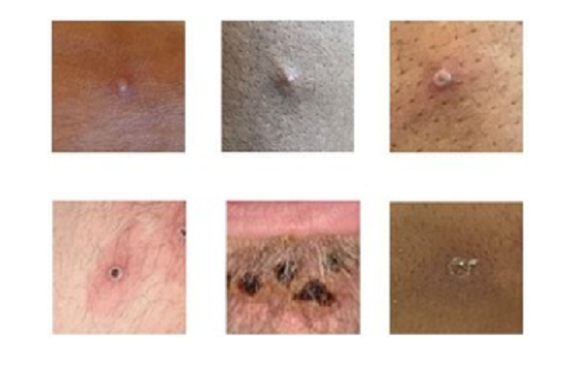 Monkeypox: What you need to know