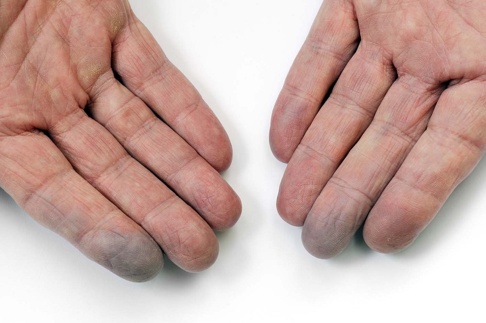 Raynauds: The Importance of Keeping Warm