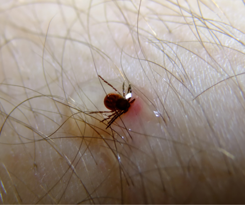 Tick Alert – check for bites as outdoor season begins. 